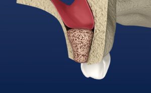 Model of a sinus lift and bone grafting