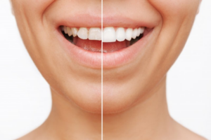 Side-by-side of teeth before and after dental veneers